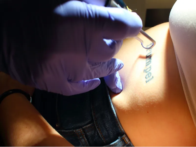 Tattooentfernung in Berlin bei Dr. Pettker
